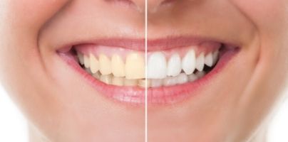 tooth-whitening